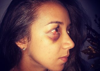 Modelo colonense denuncia que fue golpeada por su novio