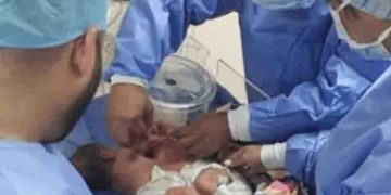 Siamesas evolucionan satisfactoriamente