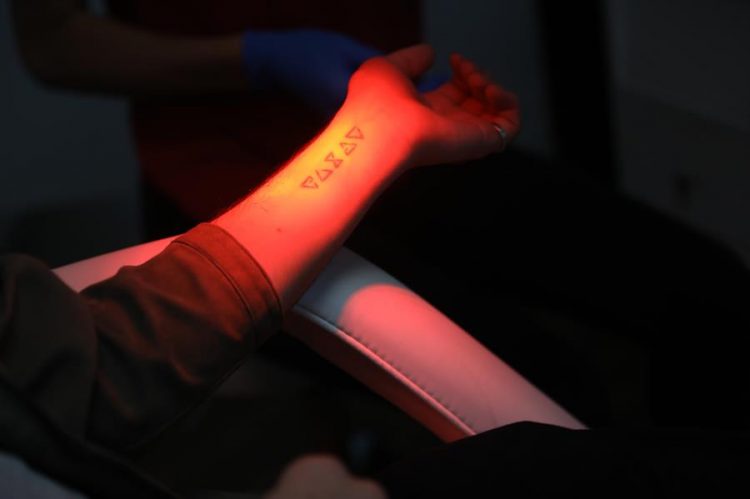 Detalle de un tatuaje borrado el 12 de febrero del 2021 en la clínica MissInk, en Ciudad de México (México). EFE