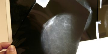 Un estudio concluye que un tipo cáncer mama se podría curar sin quimioterapia