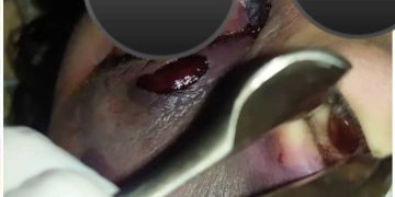 Gobernador de Mérida confirma el primer caso de hongo negro