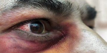 ¿Qué es el hongo negro y cómo se contagia?