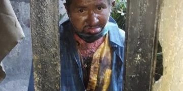 Fallece hombre que fue rociado de gasolina y quemado en Táchira