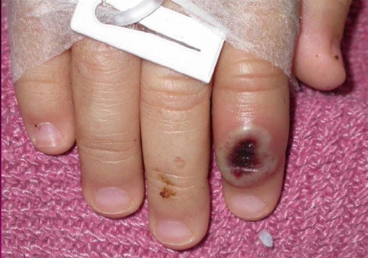 Fotografía del Centro Estadounidense de Control de las Enfermedades (CDC) en la que se aprecia el dedo de un niño infectado por la llamada ""viruela de mono"" (monkeypox). EFE/Cortesía CDC