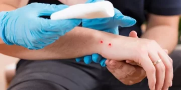 Aumenta el número de pacientes por mordedura de serpientes en el estado Trujillo