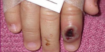 La OMS eleva a 643 los casos de viruela del mono, 142 de ellos en España