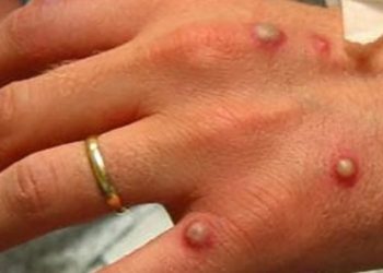 Pacientes de enfermedades crónicas tienen mayores riesgos si se contagian con el virus del mono