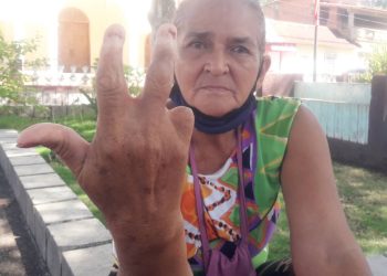 Damaris Cabrita “persona discapacitada” despedida de la Alcaldía de Motatán