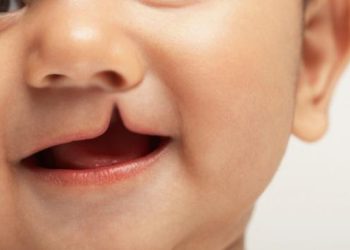 El valor de una sonrisa: Hendidura Labio Palatina