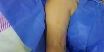 Táchira/ Buscan activamente a un hombre que quemó a su esposa al rociarle gasolina