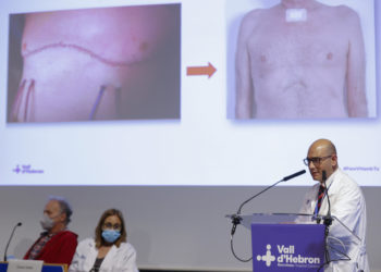 Hospital español practica el primer trasplante pulmonar robótico sin abrir el tórax