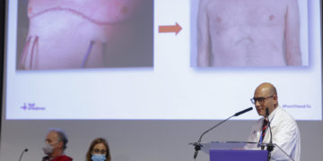 Hospital español practica el primer trasplante pulmonar robótico sin abrir el tórax