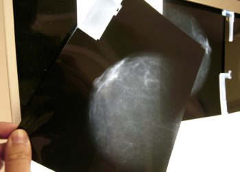 Un estudio internacional avala el papel de la terapia endocrina contra el cáncer de mama