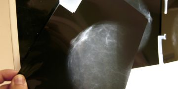 Un estudio internacional avala el papel de la terapia endocrina contra el cáncer de mama