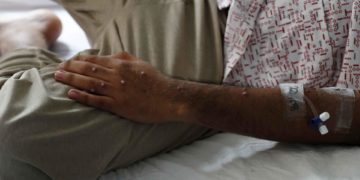 La OMS levanta la emergencia internacional por la viruela símica tras 10 meses de alerta