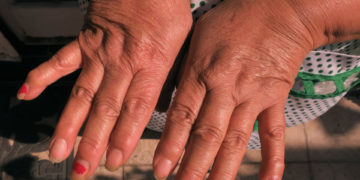 Mil millones de personas sufrirán osteoartritis en 2050, según un estudio