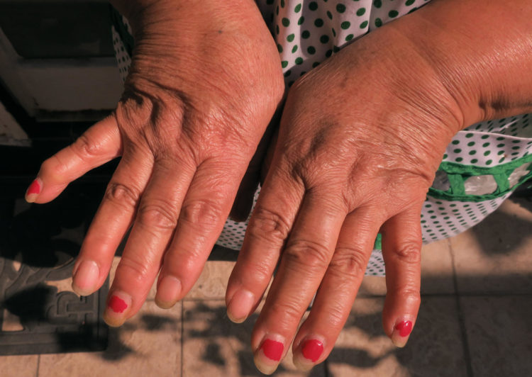 Una mujer muestra su manos con artritis reumatoide en una imagen de archivo. EFE/Alex Cruzááá
