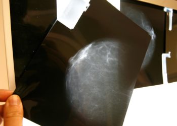 Descifran el mecanismo de una proteína clave en la metástasis de cáncer de mama