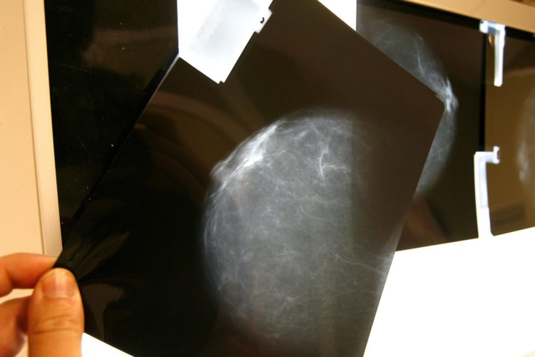 En la imagen de archivo, detalle de una prueba radiológica de detección precoz del cáncer de mama. EFE/Chema Moya