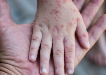 Anuncian plan de vigilancia epidemiológica contra la viruela del mono
