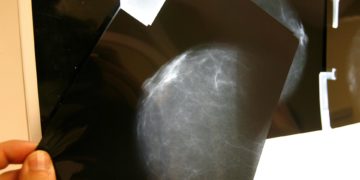 Una nueva estrategia alarga supervivencia en cáncer de mama metastásico en etapa precoz