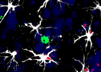 Identifican las células que facilitan la metástasis cerebral