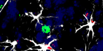 Identifican las células que facilitan la metástasis cerebral