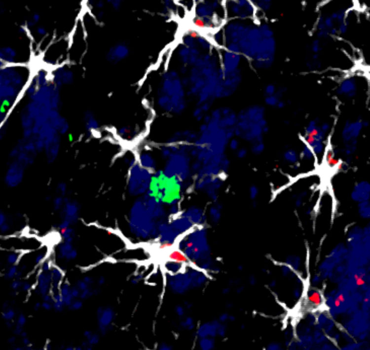 Células en torno a una metástasis cerebral en modelo animal: varias células cerebrales (astrocitos, blancas) rodean a una célula del sistema inmunitario (linfocito, verde). Algunos de ellos han empezado a activar el factor (rojo) inductor de la molécula TIMP1, que les permitirá inhabilitar la acción del linfocito contra las células tumorales. Crédito: CNIO.