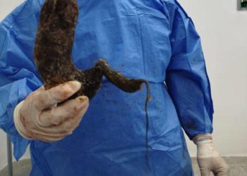 Adolescente boconesa fue operada por el síndrome de rapunzel