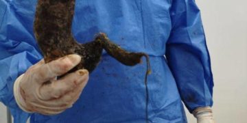 Adolescente boconesa fue operada por el síndrome de rapunzel