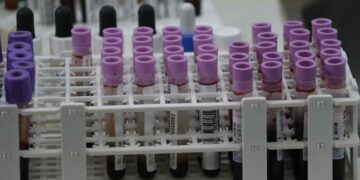 Una prueba de sangre basada en genes detecta signos tempranos de recaída en melanoma