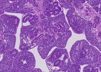 Las alteraciones genéticas del cáncer renal infantil abren la puerta a nuevos tratamientos