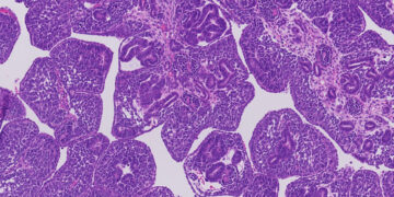 Las alteraciones genéticas del cáncer renal infantil abren la puerta a nuevos tratamientos
