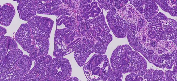 Histología característica de un tumor de Wilms en un recién nacido provocado por una mutación del gen FOXR2. Crédito: Ronald de Krijger / Centro Princesa Máxima de Oncología Pediátrica