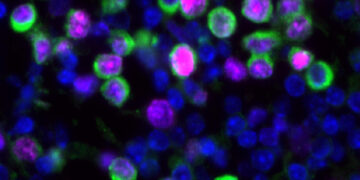 Virus respiratorios pueden despertar y promover la metástasis pulmonar del cáncer de mama