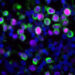 Virus respiratorios pueden despertar y promover la metástasis pulmonar del cáncer de mama