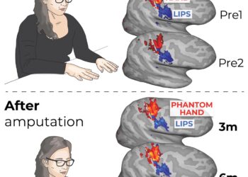 El mapa que el cerebro tiene de nuestro cuerpo no cambia tras una amputación