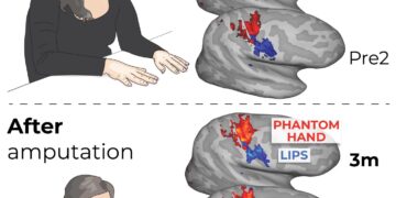 El mapa que el cerebro tiene de nuestro cuerpo no cambia tras una amputación