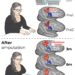 El mapa que el cerebro tiene de nuestro cuerpo no cambia tras una amputación