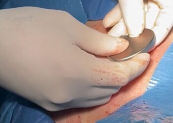 Hospital Universitario de Los Andes inició implantación de marcapasos