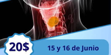 Sociedad Anticancerosa de Boconó invita a jornada de despistaje de cáncer de laringe 